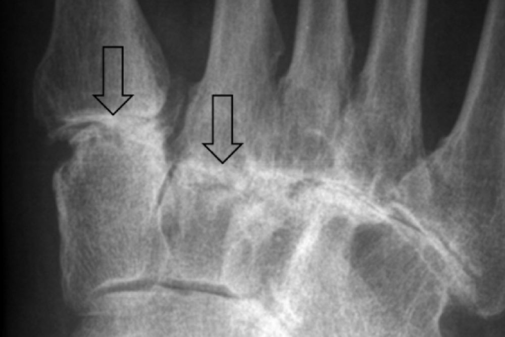 Foot Joint Arthritis Treatment