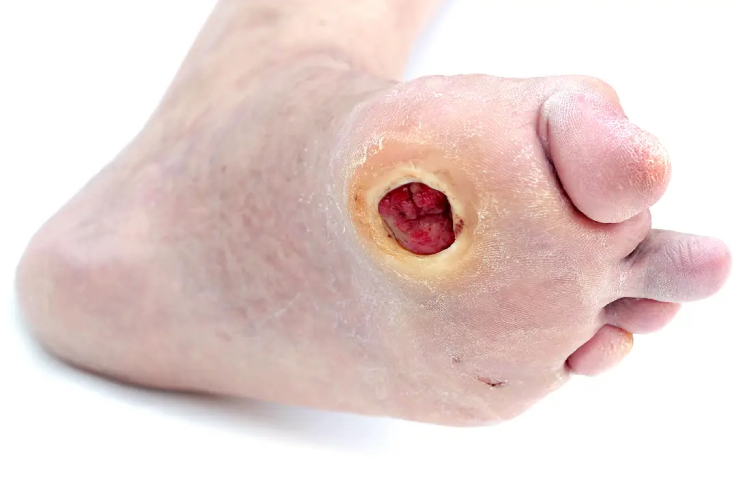 Diabetic Foot Neuropathy Treatment