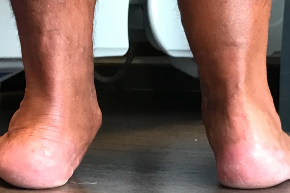 Flat Foot Treatment