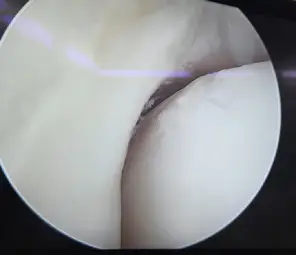 Arthroscopy Thumbnail