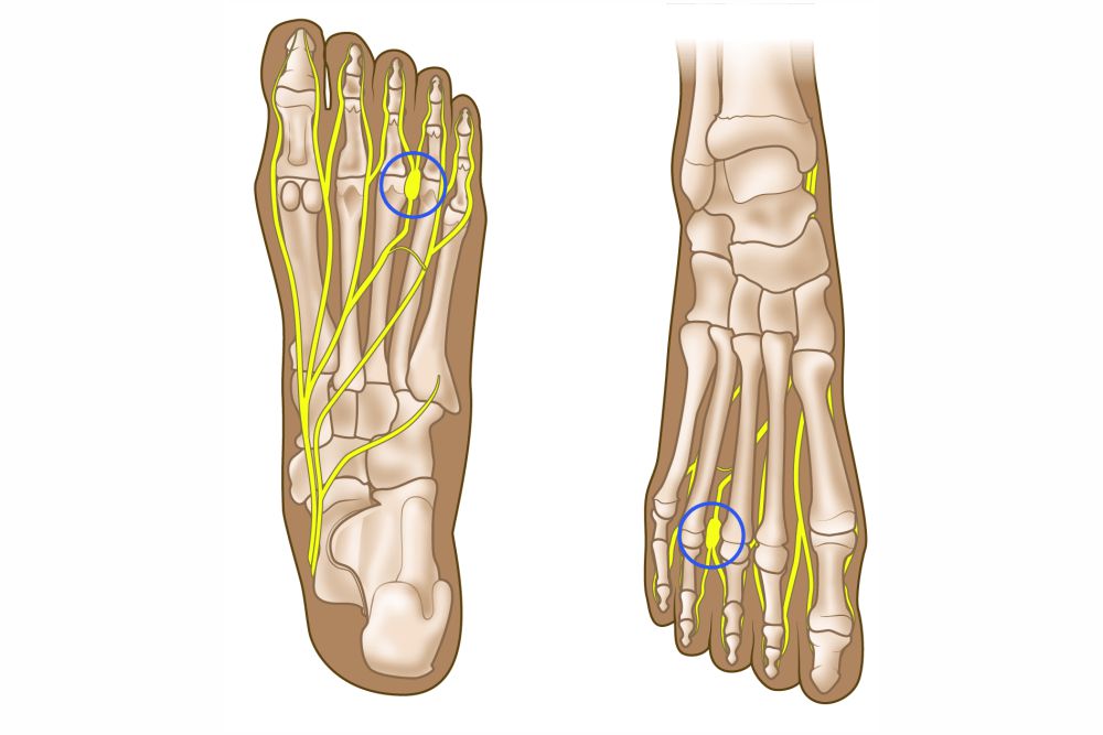 Mortons Neuroma